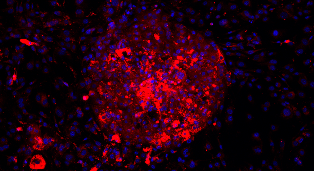 Micropatterned primary human hepatocytes dosed with free fatty acids and stained for lipid accumulation (red) and DAPI (blue).