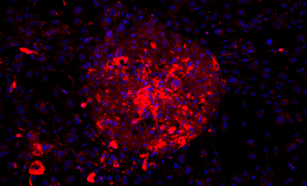 Micropatterned primary human hepatocytes dosed with free fatty acids and stained for lipid accumulation (red) and DAPI (blue).